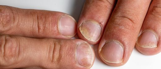 Nagelpsoriasis T Pfeln Gel Lflecken Kr Meln Gel