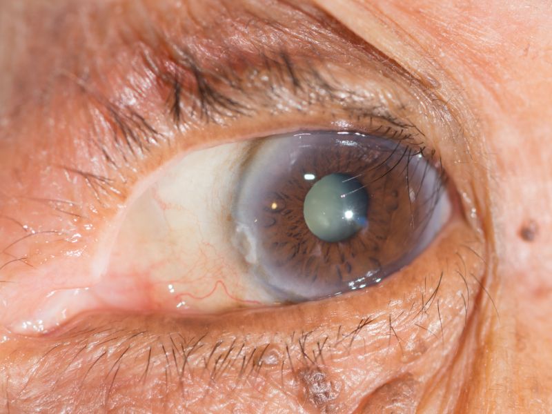 Grauer Star: Augenkrankheiten im Alter