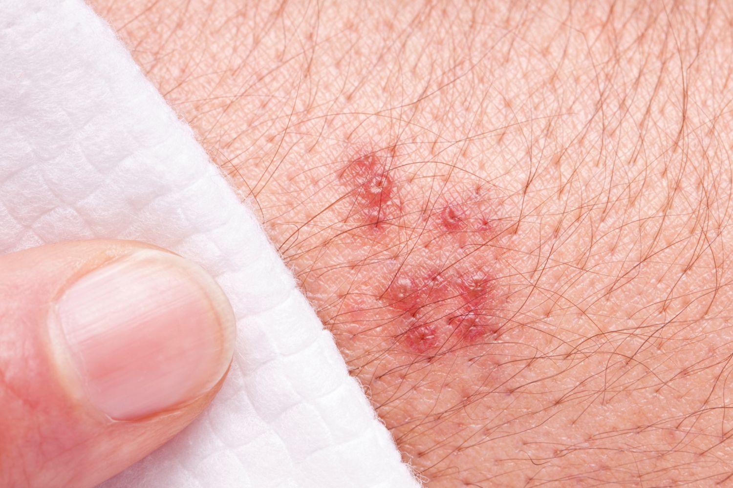 Does A Herpes Outbreak Itch When Healing