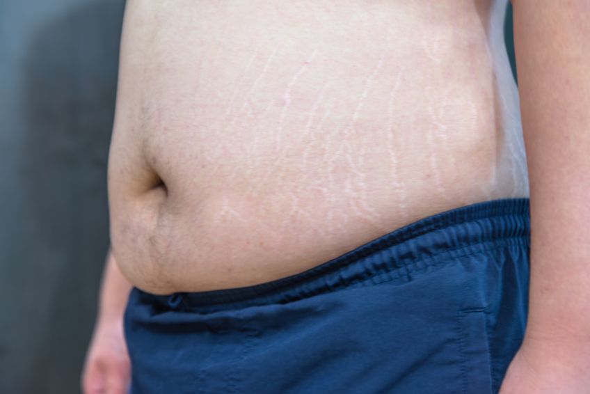 Schlaffer Bauch Nach Dem Abnehmen 2300 Kalorien Diaten Fur Manner Gewichtsverlust