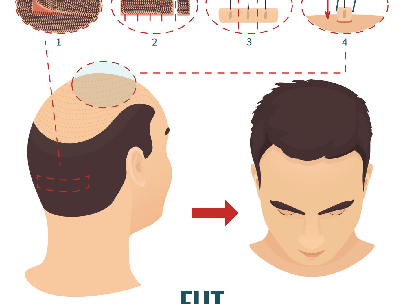 Haartransplantation Kosten Ablauf Methoden Risiken