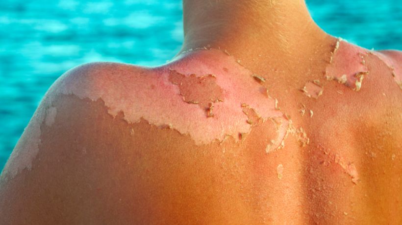 Was hilft gegen Sonnenbrand? • Die besten Hausmittel
