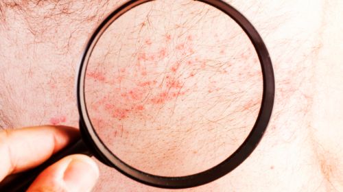 Hautausschlag: Welche Krankheit steckt dahinter?