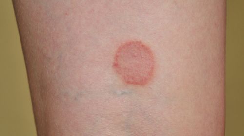 Keratosis Pilaris Reibeisenhaut Was Hilft Wirklich