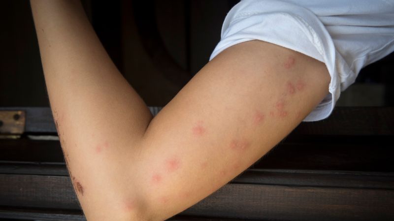 Mückenstich oder flohbiss