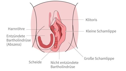 An vagina knoten der Furunkel an