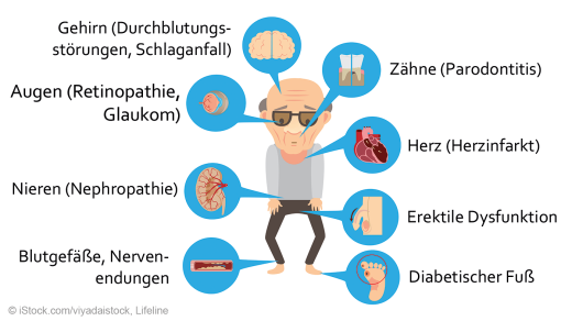 Begleit- Und Folgeererkrankungen Bei Diabetes