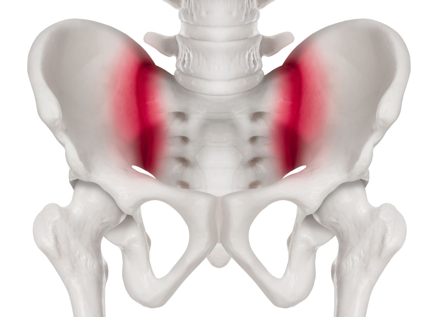 sacroiliitis-ursachen-symptome-und-sp-tfolgen