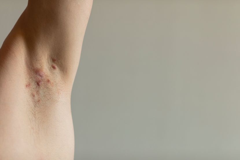 46+ Akne inversa bilder intimbereich , Akne inversa • Was hilft gegen die Hautkrankheit?