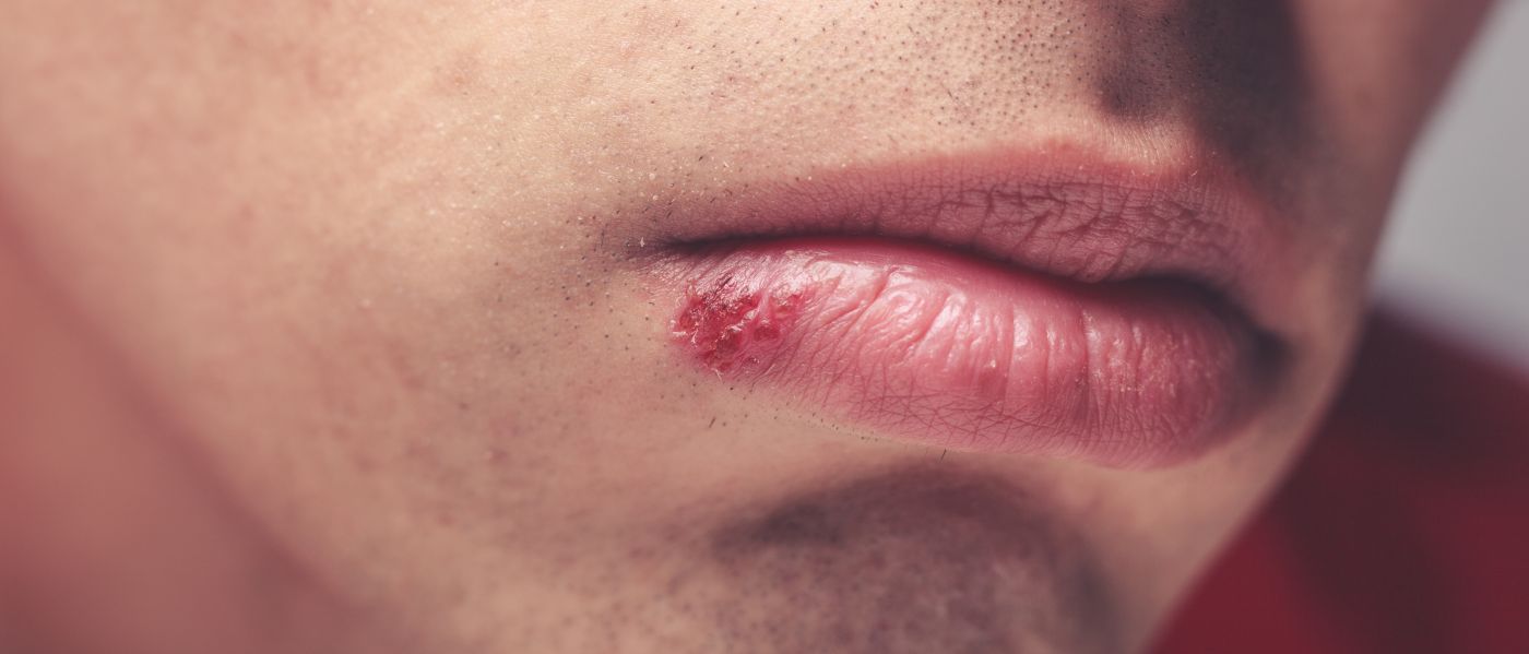 Lange bleibt genitalis wie herpes Dauer von