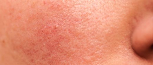 Rosacea Symptome Behandlung