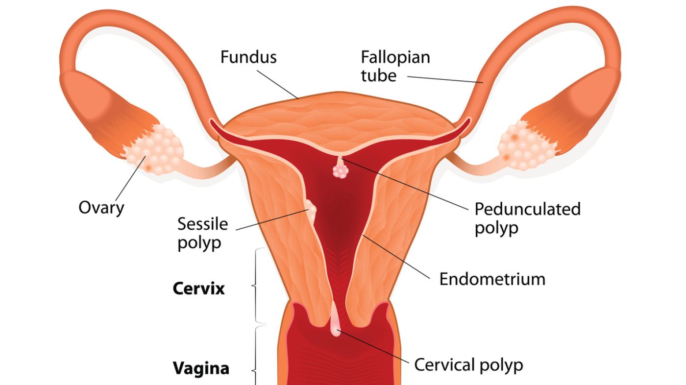 Polypenentfernung gebärmutter