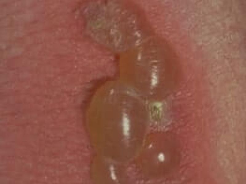 Bild von Hautkrankheit Bullöses Pemphigoid