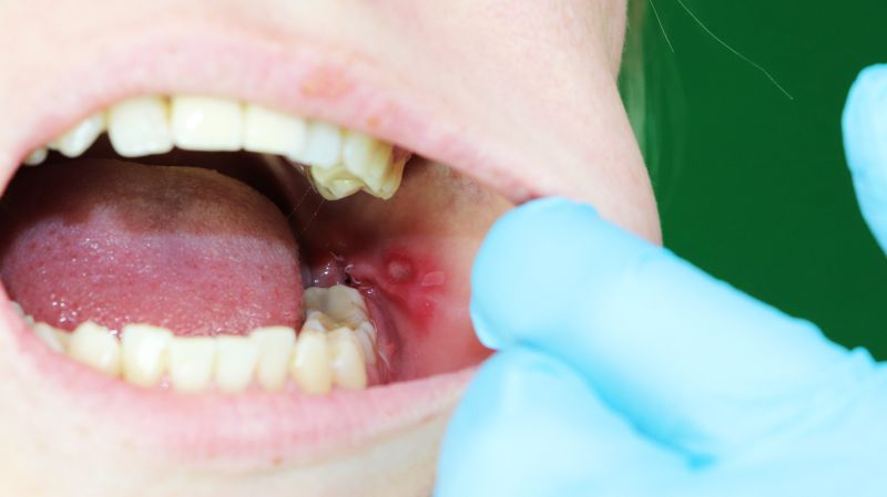 Zunge unter der zungenpiercing entzündung Zungen Piercing