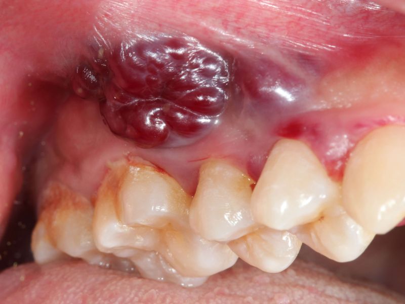 Mundkrankheiten: Krebs in der Mundhöhle
