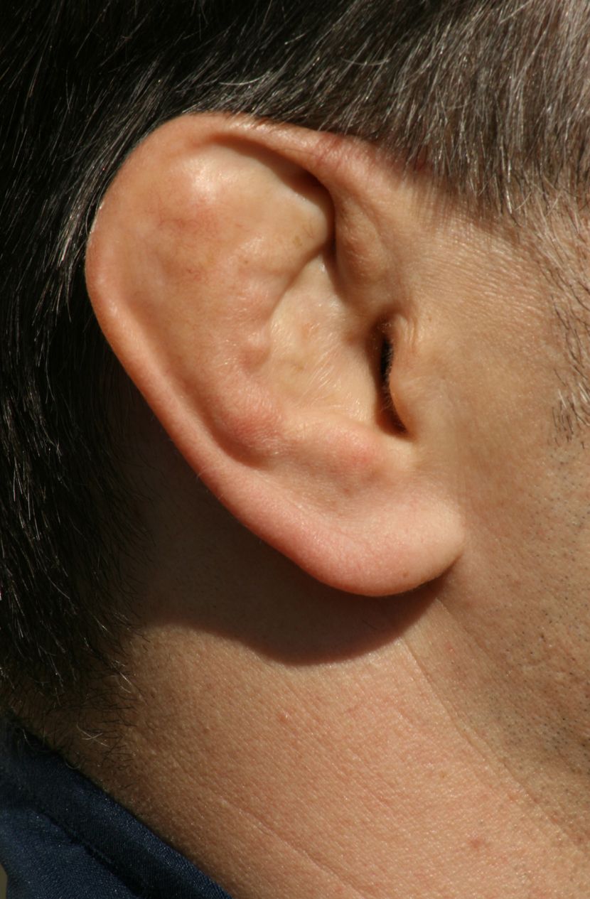 Ohren geschwollene Gehörgangsentzündung (Otitis