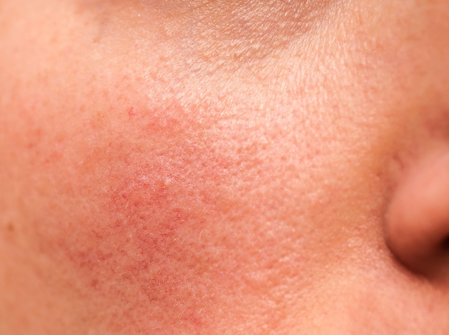 Rosacea Symptome Behandlung