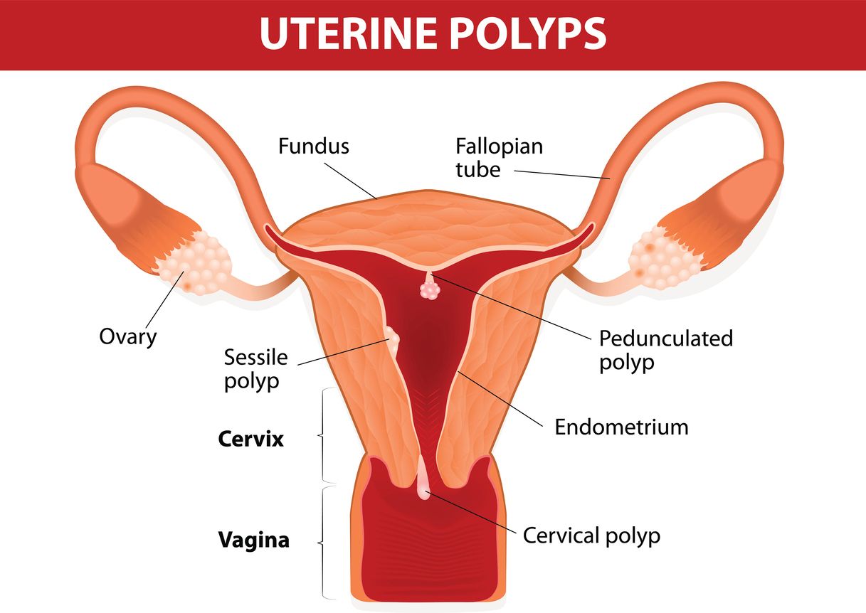 Gebärmutter polypenentfernung Blutung nach