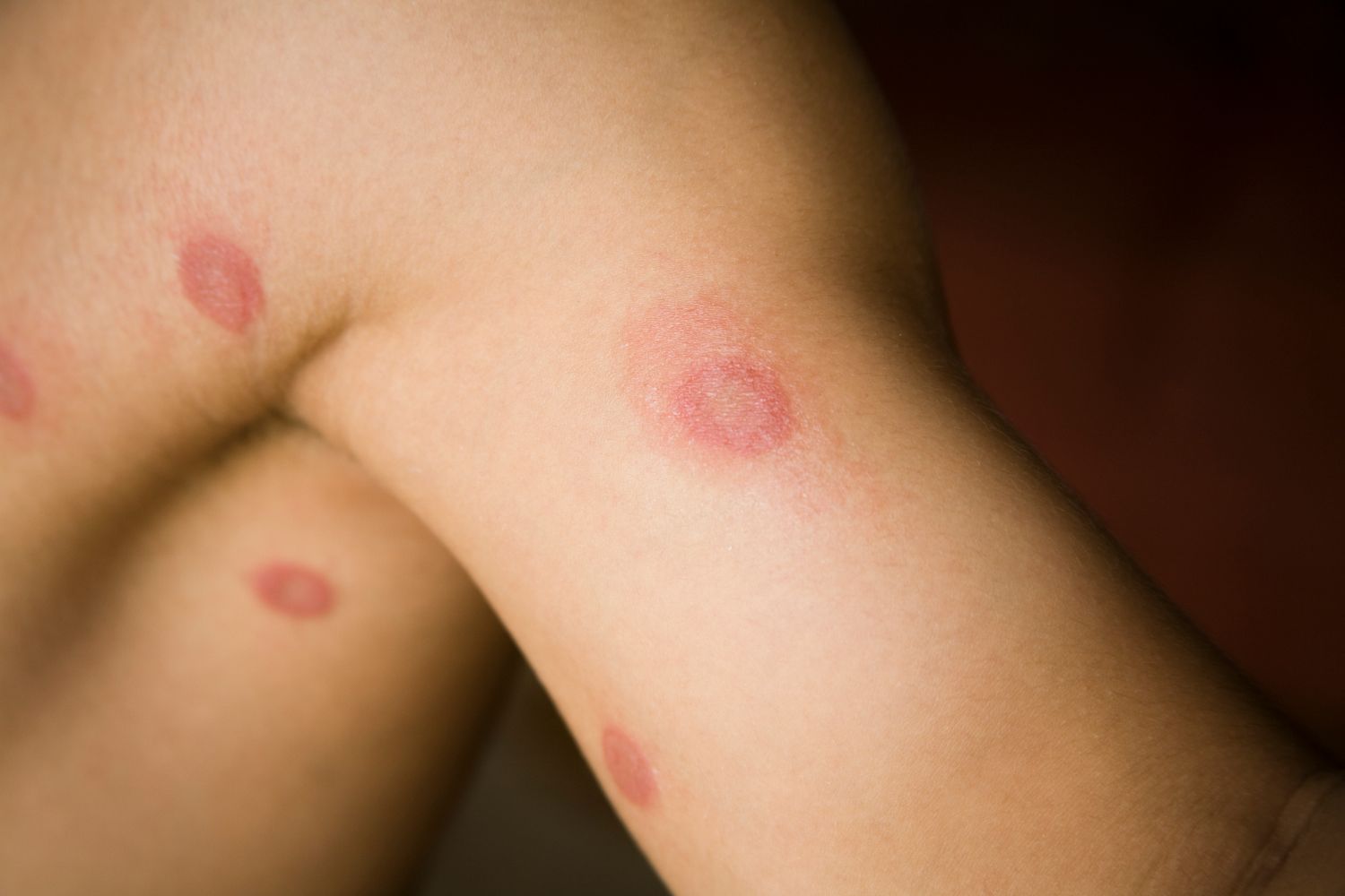 Ansteckend kleienpilzflechte Pityriasis versicolor