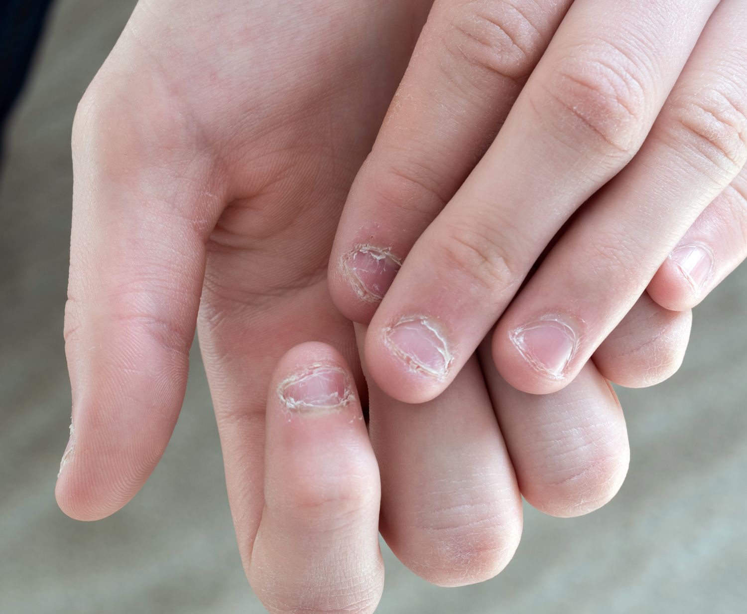 Langsrillen Flecken Co Nagelkrankheiten Erkennen Squoval Naegel Feilen