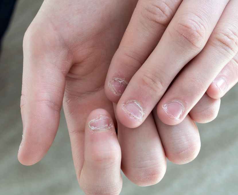 Fingernagel eiter unterm Nagelbettentzündung: Symptome