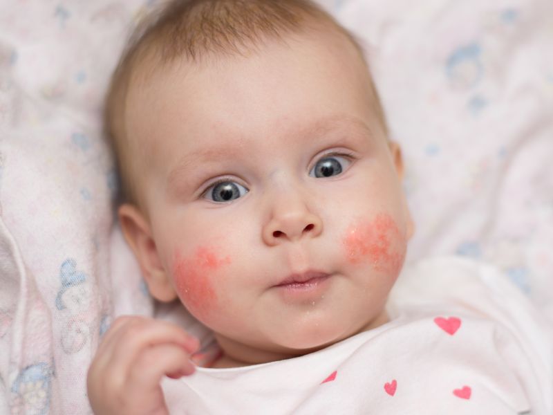 Neurodermitis beginnt bei Babys im Gesicht