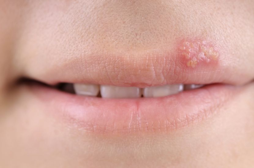 Herpes Simplex Genitalis Das Hilft Von Creme Bis Hausmittel