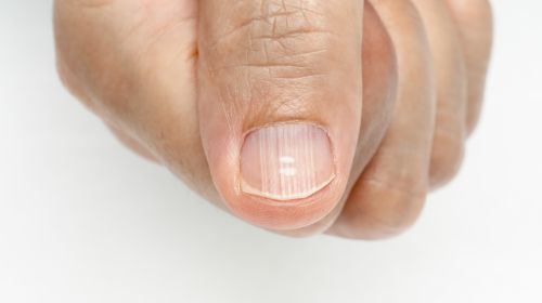 Recognize nail diseases: What longitudinal grooves and Co. mean