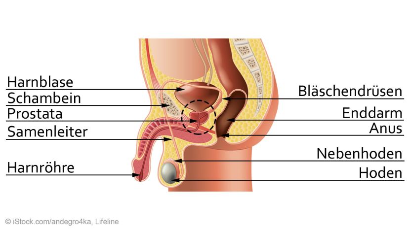 prostatitis lymphknoten