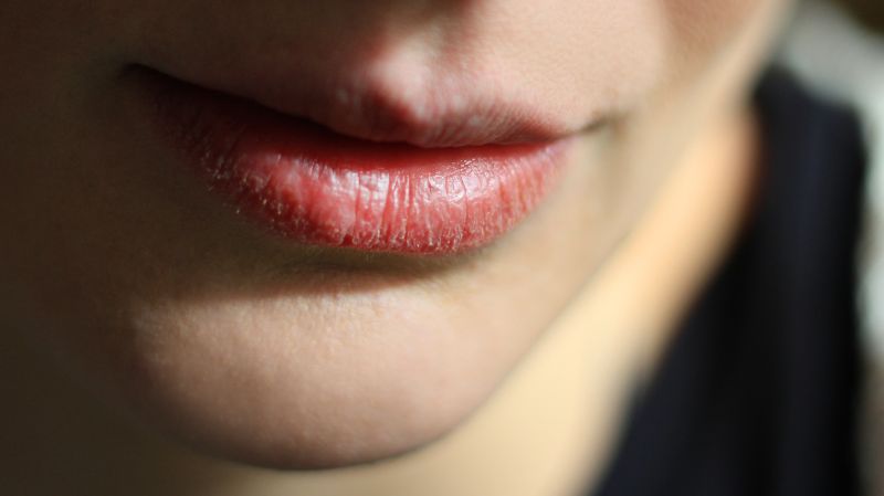 Rand entzündete lippen roter Brennende Lippen