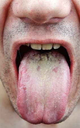 Zungenbelag grauer Belegte Zunge