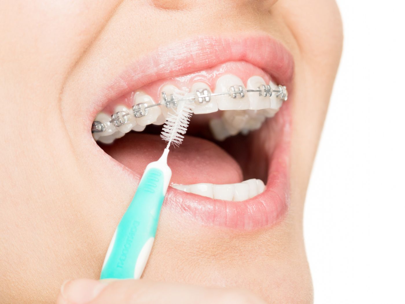 Zahnspange Kosten Bei Erwachsenen Und Reinigen
